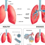 Read more about the article Lungs